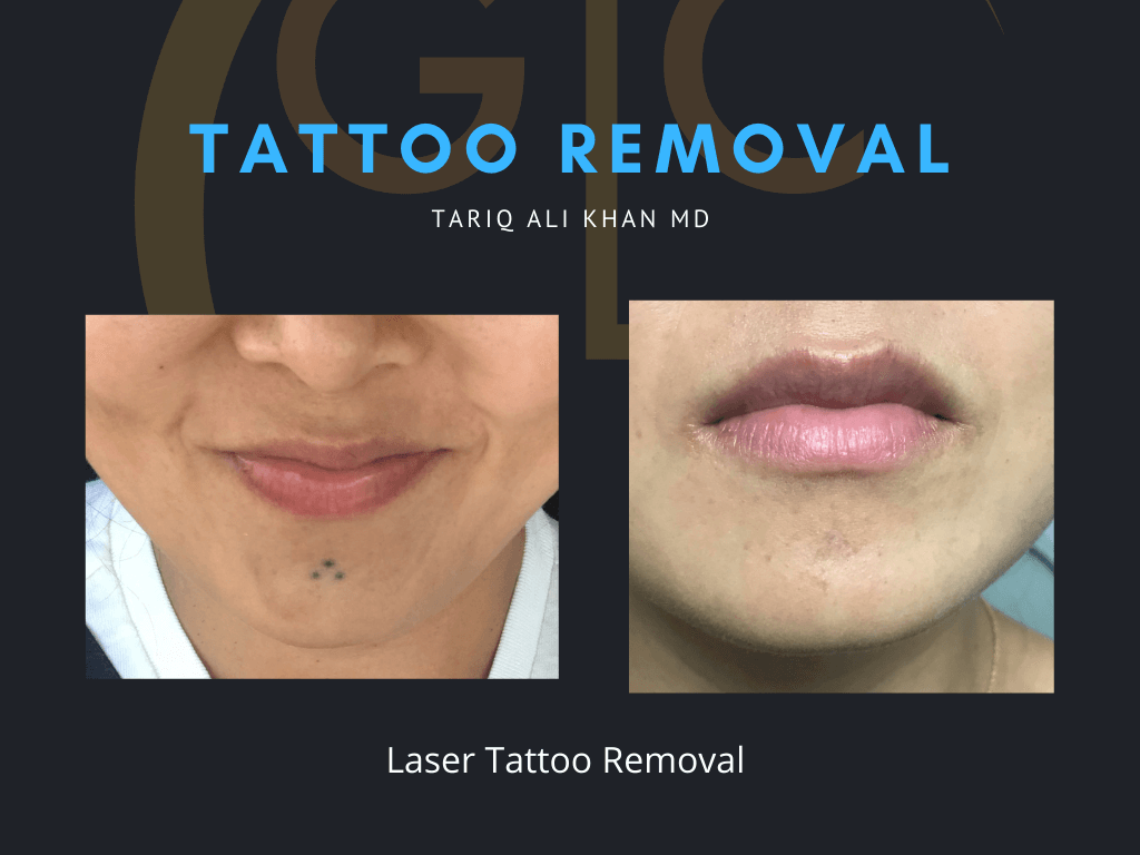 Gentle Care Laser Tustin & Long Beach CA Before and After picture - Tattoo Removal